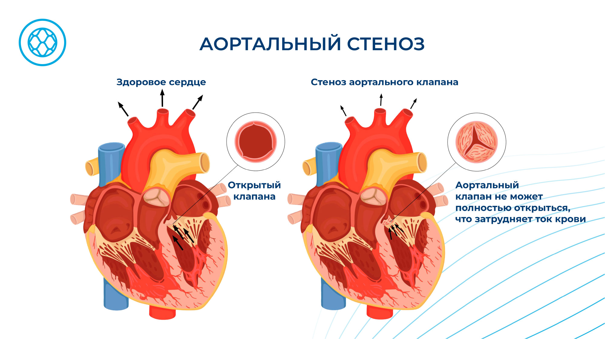 Недостаточность аортального клапана