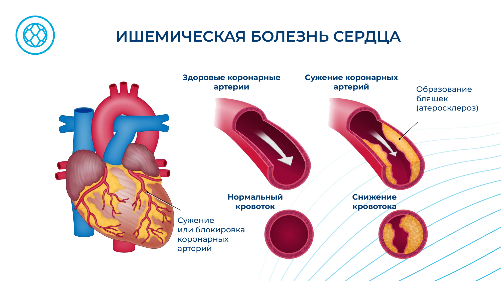 ⚕ Ишемическая болезнь сердца ➡ 【Симптомы, лечение】