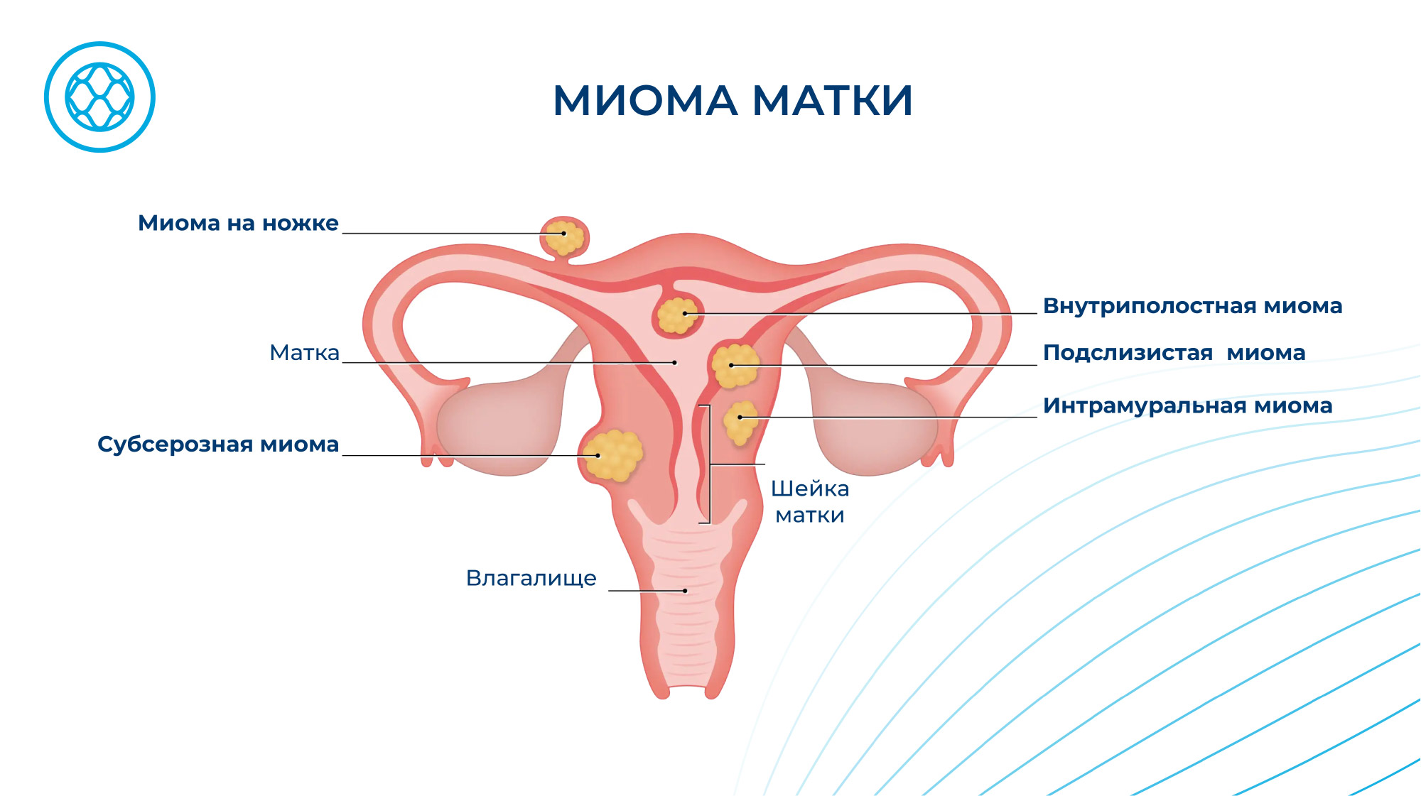 Миома матки. Диагностика и лечение. Операция удаления миомы (миомэктомия)