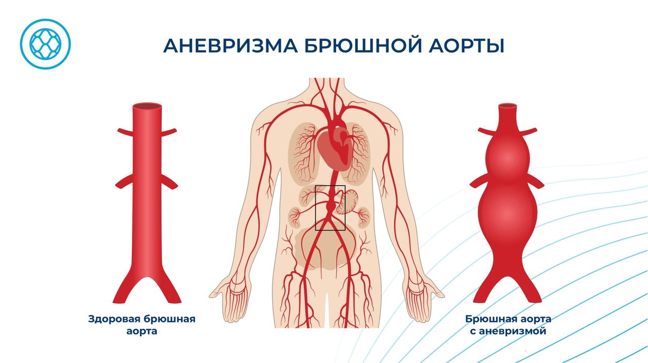 Аневризма аорты: как распознать «тихого убийцу»