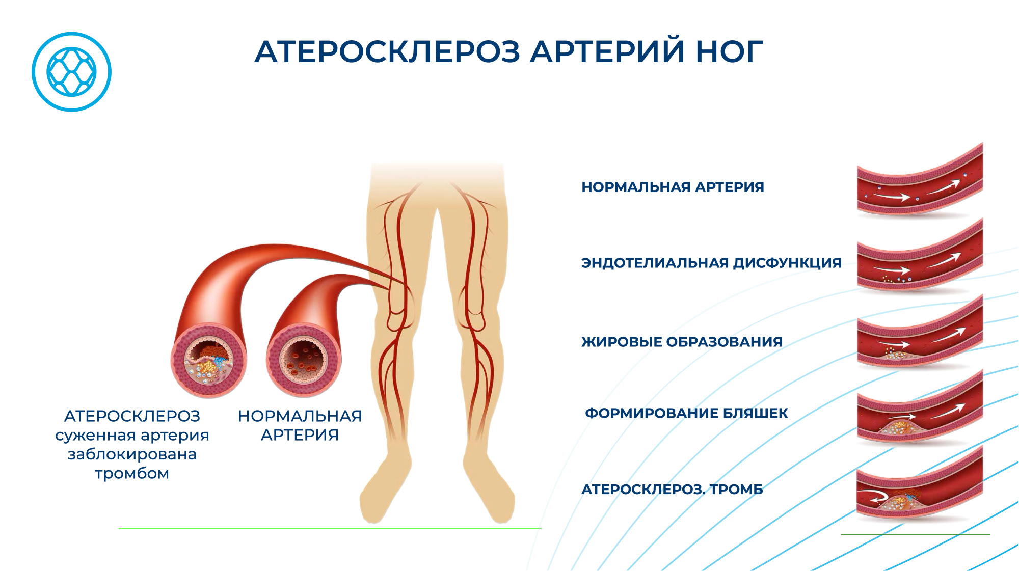 Атеросклероз сосудов ног