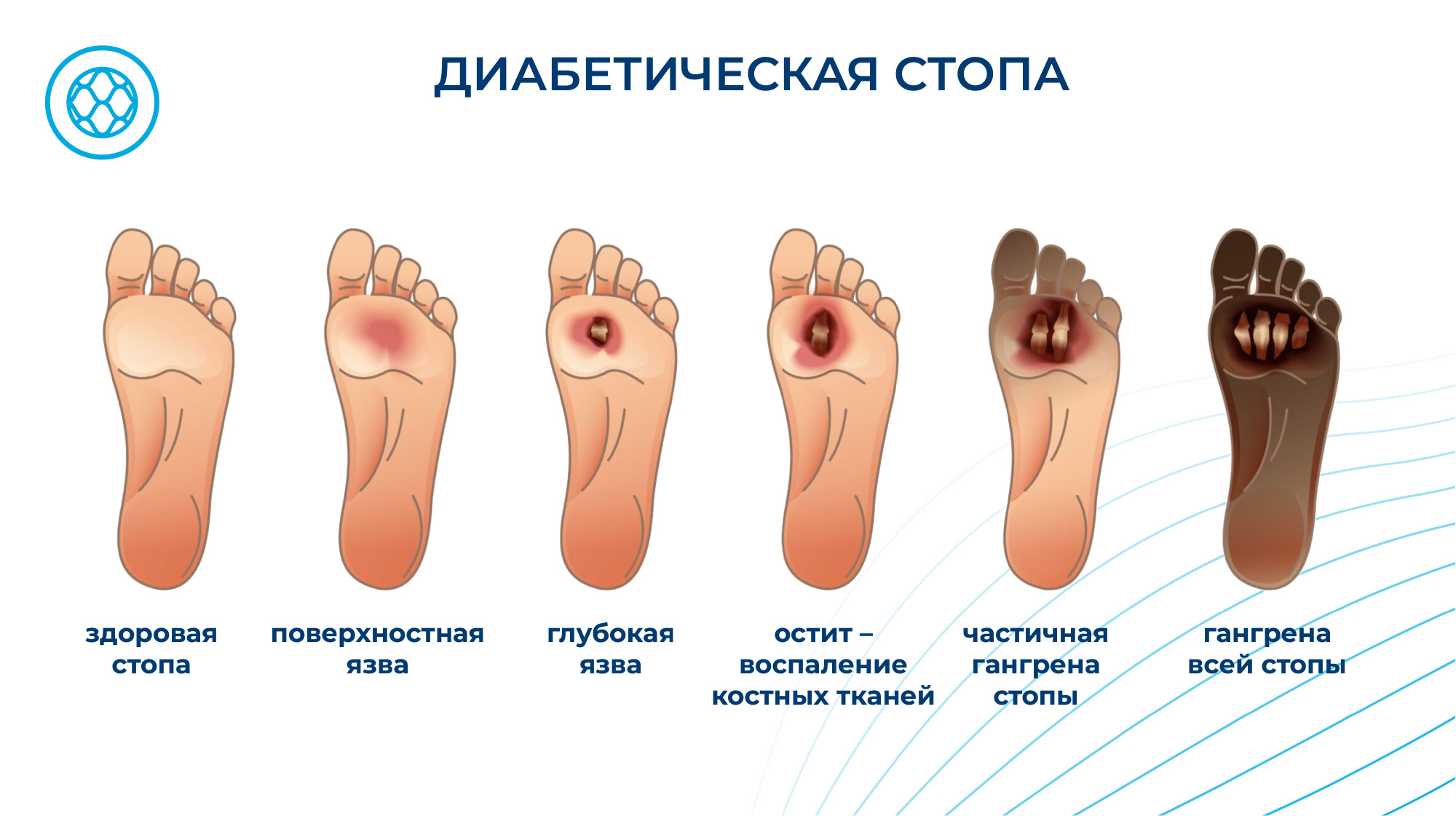   Синдром диабетической стопы: