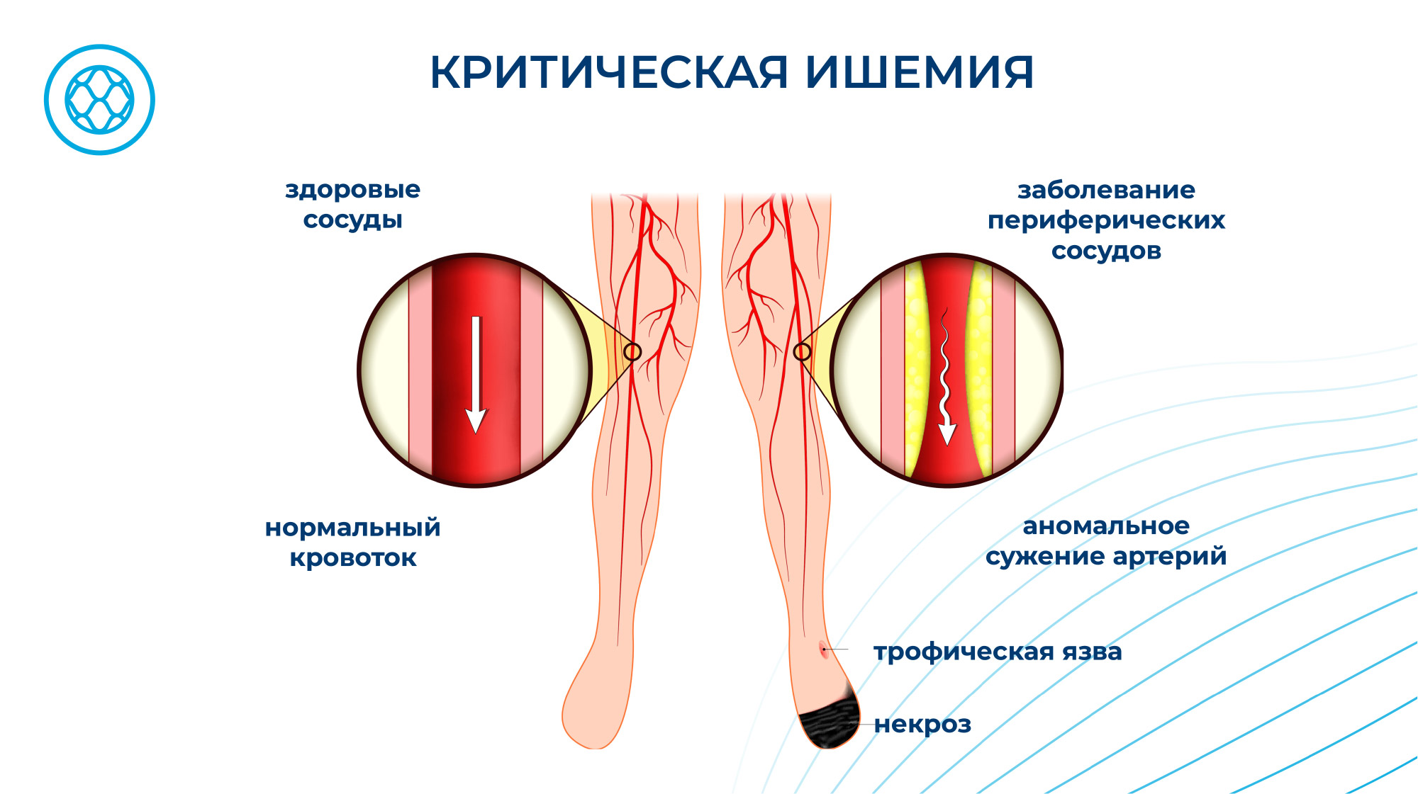 Критическая ишемия нижних конечностей