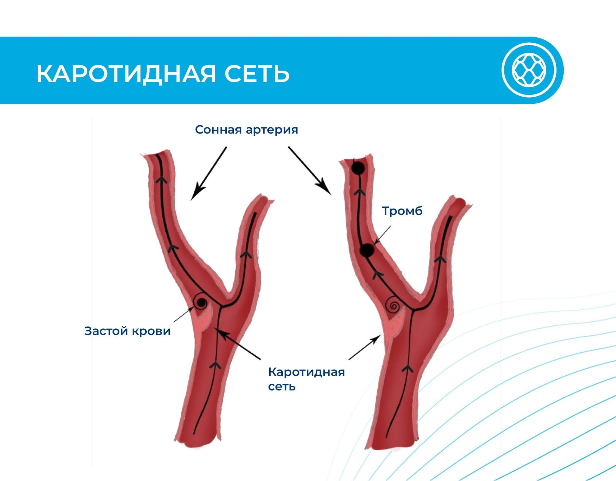 Врачи «Инномеда» нашли и вылечили редкую патологию — каротидную сеть в сонной артерии