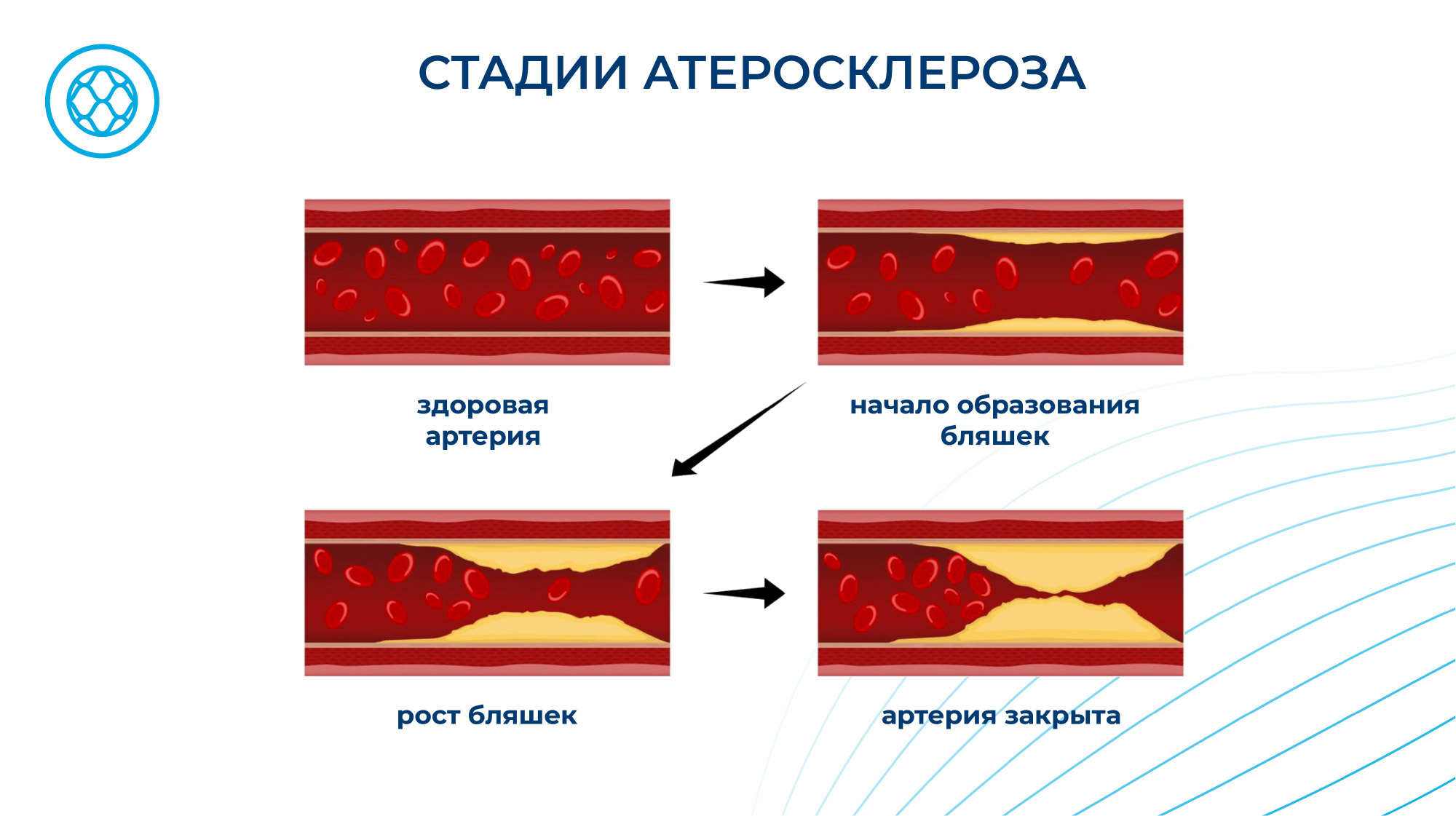 Атеросклероз