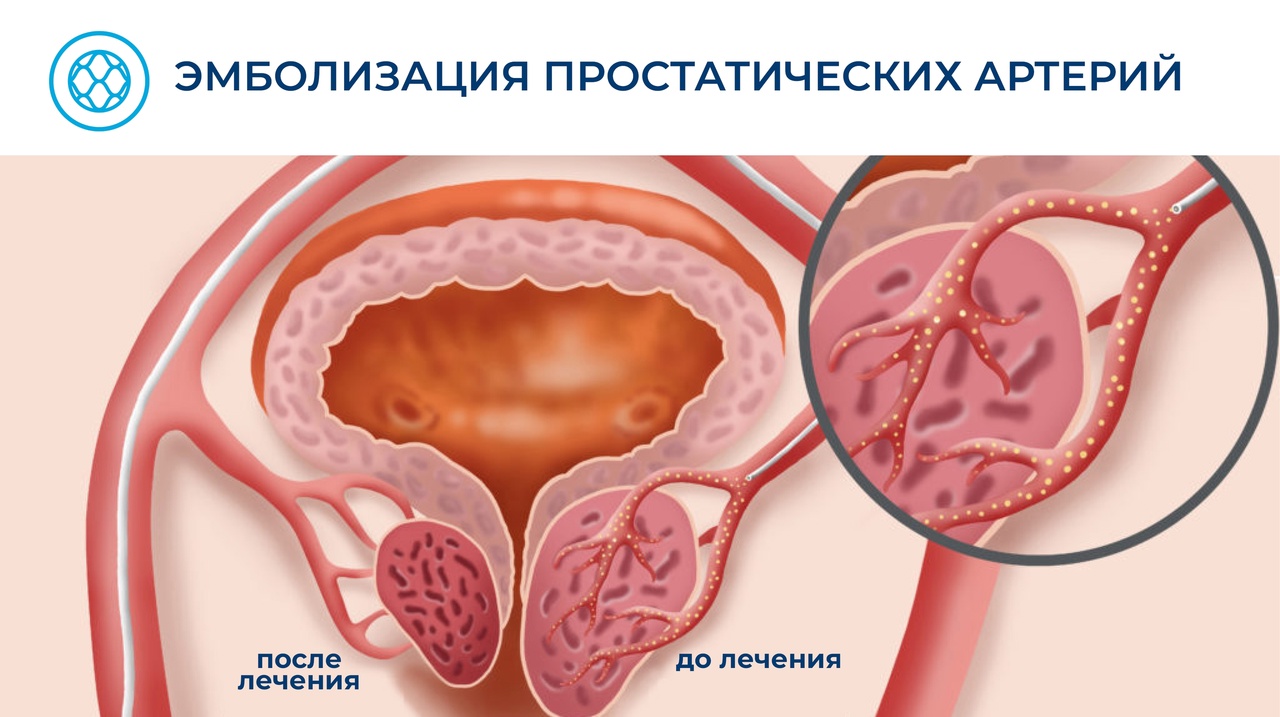 Аденома простаты: о чём молчат мужчины